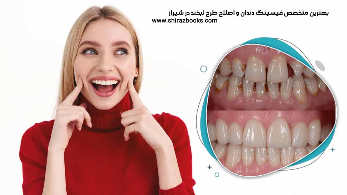 10 بهترین متخصص فیسینگ دندان و اصلاح طرح لبخند در شیراز